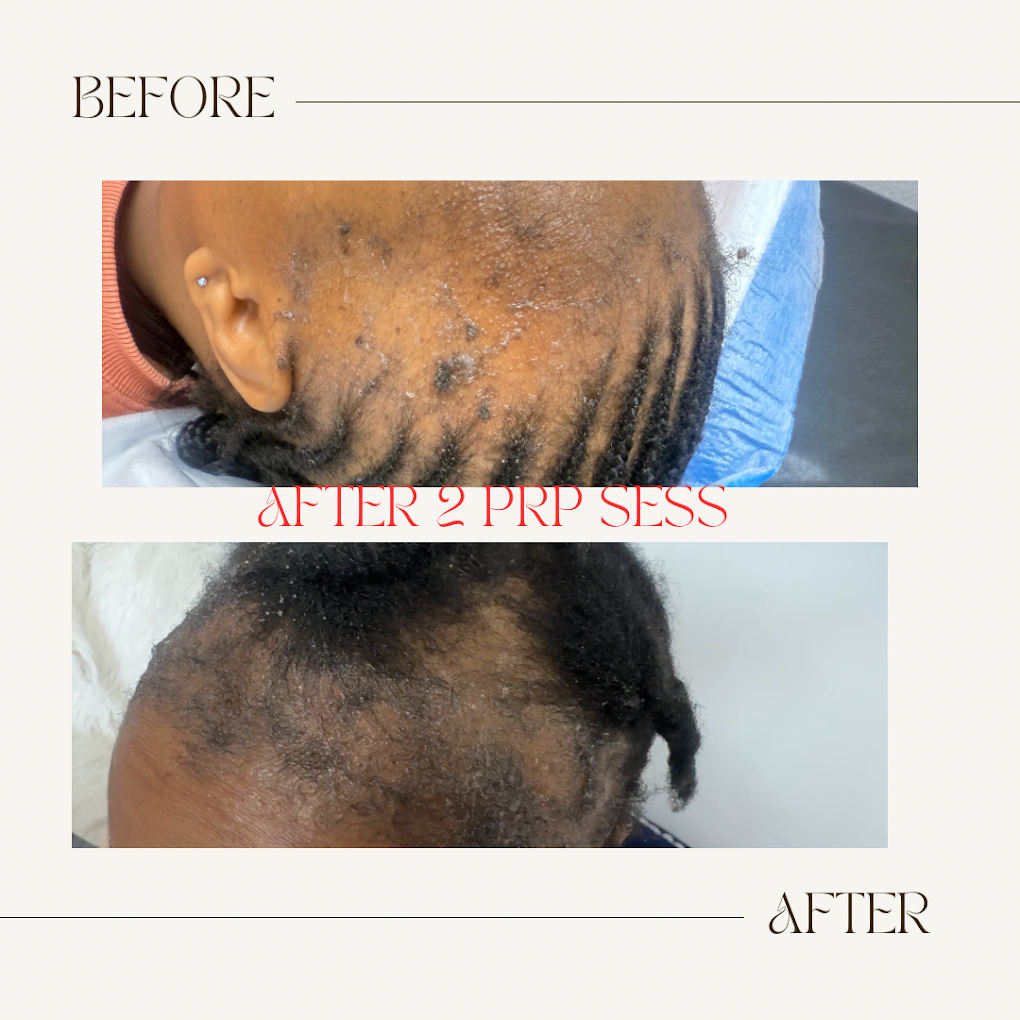 Scalp before and after two PRP hair restoration sessions