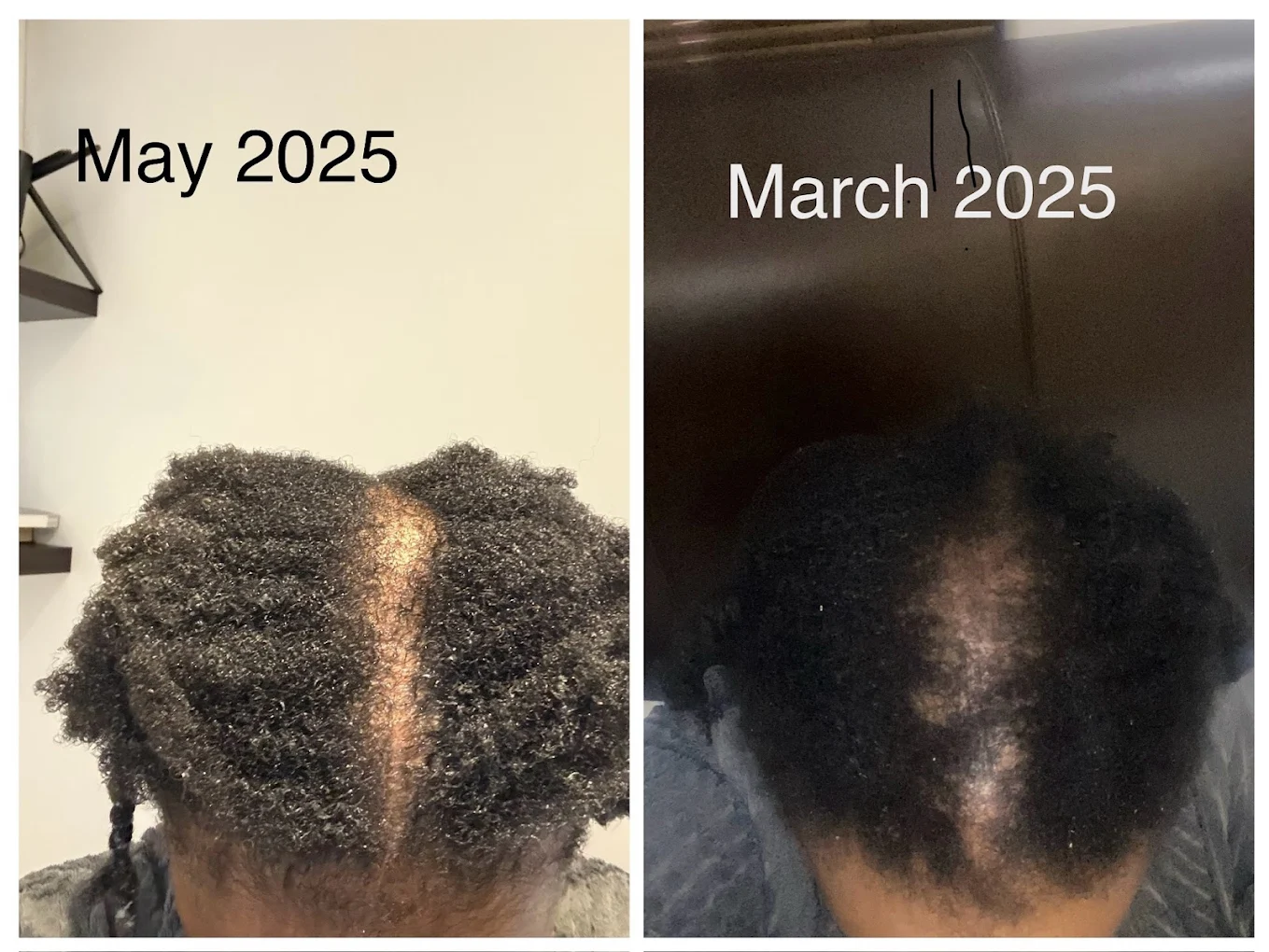 Parting line progress between March and May after PRP treatment