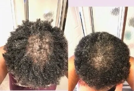 Crown density before and after PRP hair restoration treatment